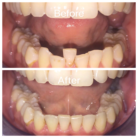 Clear Aligners Treatment