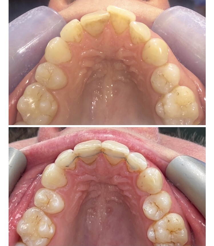 Clear Aligner treatment before & after