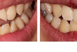 Before & After :: Different Dental Procedures & Treatments