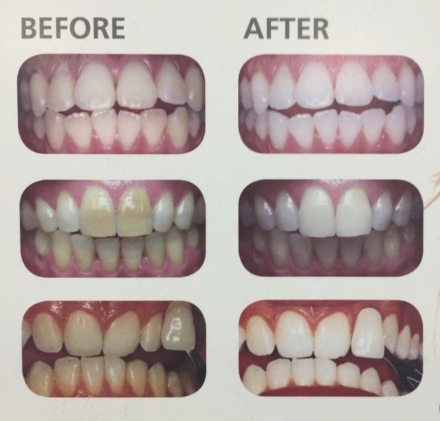 Pre & Post Op teeth bleaching treatment