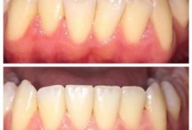 Clear Aligner Treatments
